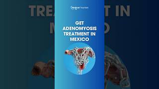 If you have adenomyosis get your treatment in Mexico ✈️ – Medical Tourism gynecology mexico [upl. by Kerin]