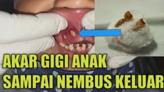 Akar Gigi Anak Sampai Nembus Gusi Ulcus Decubitus [upl. by Inamik]