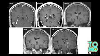 QUOI DE NEUF DOC Images choquantes Un homme se fait dévorer le cerveau par un ver [upl. by Tade]