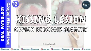 Median rhomboid glossitis  Kissing lesion  Central papillary atrophy  Dr Paridhi Agrawal [upl. by Ifill]