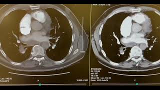 CT Angio Pulmonary Embolism WIth Contrast [upl. by Huberto]