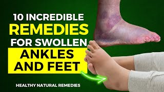 10 Incredible Remedies For Swollen Ankles and Feet [upl. by Truman468]