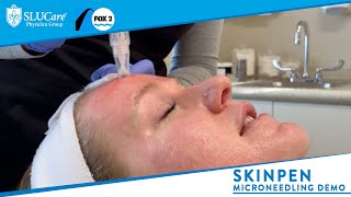 Skinpen Microneedling How it Works amp Demonstration  SLUCare MedSpa [upl. by Alimrahs863]