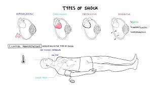 Approach to Shock  types hypovolemic cardiogenic distributive anaphylaxis pathology treatment [upl. by Bluefarb]