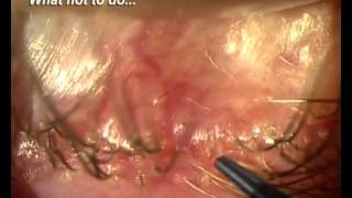 Demodex Blepharitis Is it for real [upl. by Oneida679]