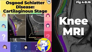 Fig 4B16 Osgood Schlatter Disease Cartilaginous Stage [upl. by Retep]