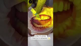 Composite bonding step by step  DentalDoubts dentalcare dentistdoctor dentaldoubts [upl. by Bashee]