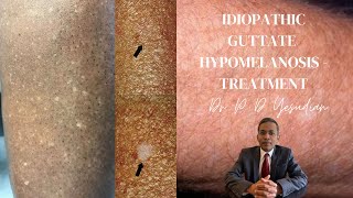 Idiopathic guttate hypomelanosis  a review with emphasis on treatment [upl. by Ricarda]