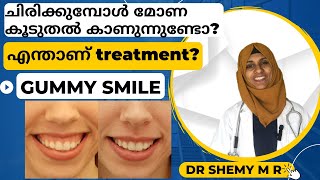 ചിരിക്കുമ്പോൾ മോണ കൂടുതൽ കാണുന്നുണ്ടോ GUMMY SMILE Correction Treatment DR SHEMY M R [upl. by Rahab187]