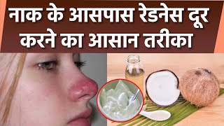 Nose Par Redness Kaise Hataye  नाक के पास रेडनेस हटाने का आसान तरीका  Boldsky health [upl. by Sherlock857]