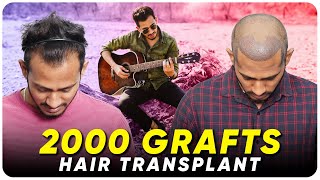 Hair Transplant in India  Best Results amp Cost of Hair Transplant in India [upl. by Ailekat]