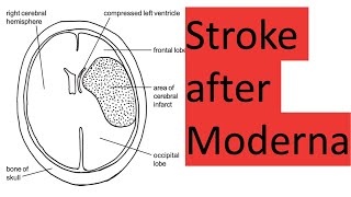 Stroke and death after Moderna [upl. by Ivers548]