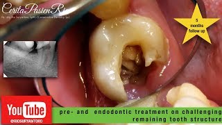 endodontic treatment with two shape files from micro mega perawatan gigi [upl. by Newcomer]