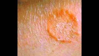 Skin Fungus Signs Symptoms Treatment HD [upl. by Eaton173]