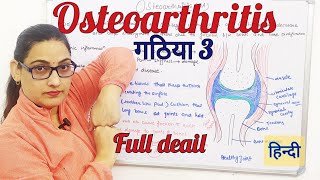 Osteoarthritis overview pathophysiology Cause SymptomsRisk Factors and Complications hindi [upl. by Onfre]