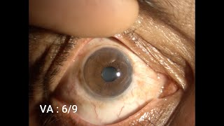 Therapeutic Keratoplasty Step by Step [upl. by Einama]