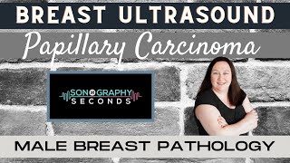 Breast Ultrasound Male Breast Pathology Papillary Carcinoma [upl. by Teerprug]