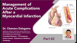 Management of Acute Complications After a Myocardial Infarction  Part 02 [upl. by Tattan]