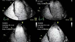 CONTRAST ECHO LV non COMPACTION  ECHOCARDIOGRAPHY cardiac ultrasound [upl. by Elem]