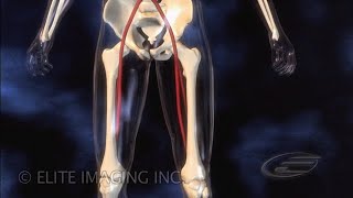 Femoral Clot Removal  Medical amp Scientific Video Production [upl. by Wallace]