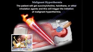 Malignant Hyperthermia  Everything You Need To Know  Dr Nabil Ebraheim [upl. by Bergquist]