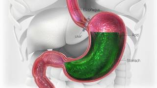 New Surgical Procedure to Help Cure Acid Reflux [upl. by Criswell]