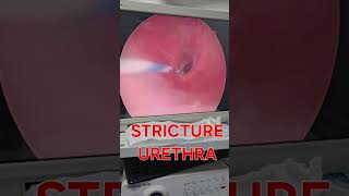 How stricture urethra look urethralstricturetreatment urethralstricture strictureurethra [upl. by Salomon]