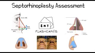 Septorhinoplasty Assessment  FRCS ENT Exam Essentials [upl. by Melak]