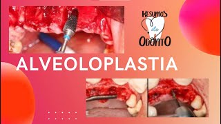 Alveoloplastia  Resumos de Odonto [upl. by Yaniv429]