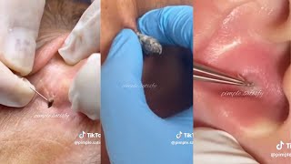 Ultimate ASMR Pimple Popping amp Blackhead Removal  Relaxation amp Satisfaction Guaranteed 🧖‍♀️ [upl. by Neeruan565]