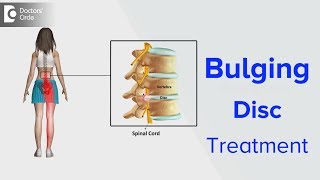 Bulging Disc Treatment  Dr Kodlady Surendra Shetty [upl. by Sewellyn762]