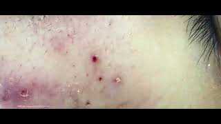 Big Cystic Acne Blackheads Extraction Blackheads amp Milia Whiteheads Removal Pimple Popping [upl. by Jeralee943]