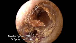 Ear Wax Removal [upl. by Idnem]