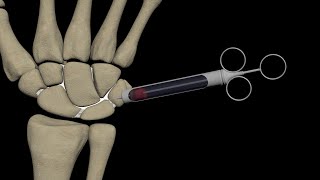 Wrist injections amp wrist arthrography [upl. by Nosle257]