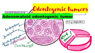 Adenomatoid odontogenic tumor HISTOPATHOLOGYradiographic featuresclinical featuresTreatment [upl. by Antoni]