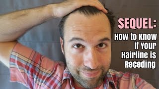 Sequel How to Know if Your Hairline is Receding [upl. by Hutchings]