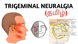 Trigeminal Neuralgia  Causes  Symptoms  Investigation  Treatment  தமிழ் [upl. by Enoitna]