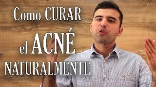 Como Curar el Acne Naturalmente [upl. by Wahkuna131]