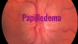 Papilledema A Swollen optic disc [upl. by Izaak537]