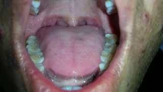 Tongue Fasciculation in MND [upl. by Novrej]