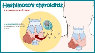 Hashimotos thyroiditis  Autoimmune diseases [upl. by Edrick33]