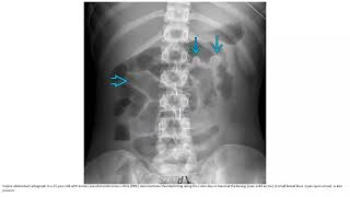 Pseudomembranous Colitis Imaging [upl. by Naibaf]