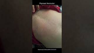 Pityriasis versicolor [upl. by Eiramanna]