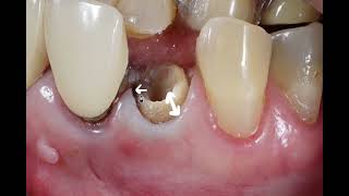 Ferrule Effect Dr Ziad F Abusidu [upl. by Lyn]