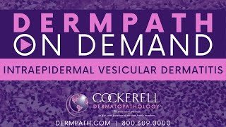 Intraepidermal Vesicular Dermatitis [upl. by Cowie]