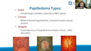 Clinical Grand Rounds in Optic Neuropathies “You’ve Got Some Nerves” [upl. by Onateag]