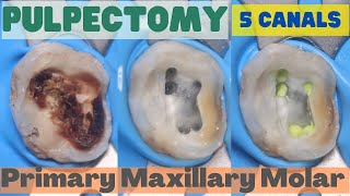 Pulpectomy ⚪️ PRIMARY MAXILLARY MOLAR 🟡 5 Canals 🔵 step by step demonstration [upl. by Newo]