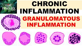 INFLAMMATION Part 9 Chronic Inflammation  GRANULOMATOUS INFLAMMATION [upl. by Esina]