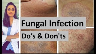 Fungal infection of skin  Dos and Donts  Dermatologist  Dr Aanchal Panth [upl. by Retsae]