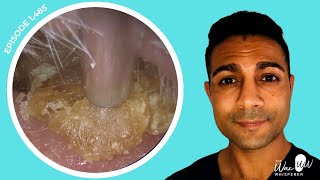 1485  Masses of Dead Skin Removed from Both Ears  Learn About Different Ear Wax Drops [upl. by Karlan]